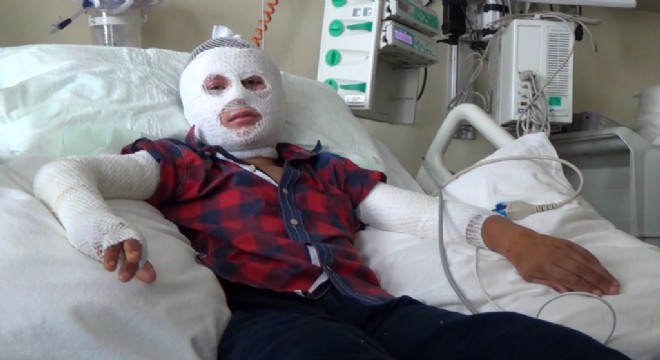 Patlayan parfüm şişesi yüzünü yaktı